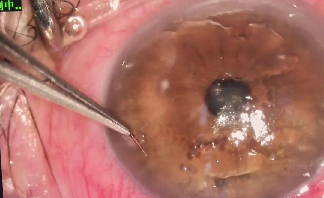 郑州一医院7天接诊8个眼睛被扎伤患者,医生:正值高发期